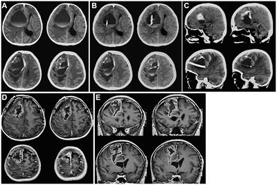 Approach to a cerebral hernia caused by an intratumoral hemorrhage of a cystic oligodendroglioma: a case report